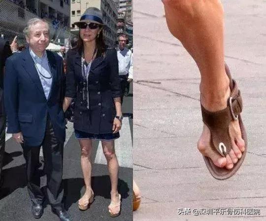 這些女明星的腳太嚇人了!高跟鞋下,拇指外翻到底有多疼?