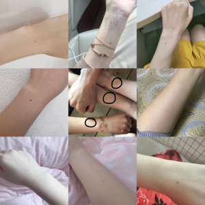 女人痣相圖解(很多人“手臂中間有顆痣”，其實是胎記痣，可能在胎兒期就已注定)
