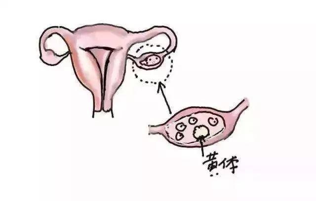 16歲女孩卵巢破裂！打開腹腔醫生驚呆了！請提醒身邊女性注意