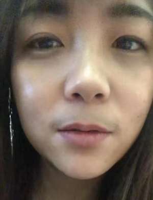 女生長胡子(女子感染新冠燒退了，卻長出了胡子，前后判若兩人)